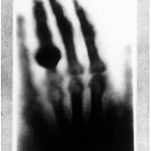 1895年——安娜·伯莎·路德维格手部的X光照片