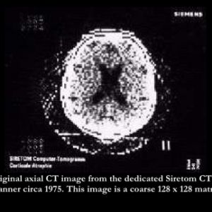 1972年——计算机轴向断层扫描CAT